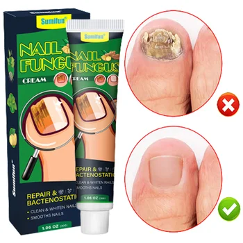 Ефективен крем за лечение на гъбички на ноктите на краката, серум за премахване на гъбички на ноктите на краката, противоинфекционный гел за лечение на паронихии и на онихомикоза